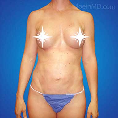 Breast Augmentation-After