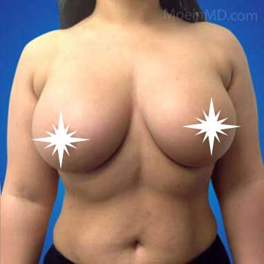 Breast Augmentation-After