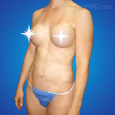 Breast Augmentation- LA-After