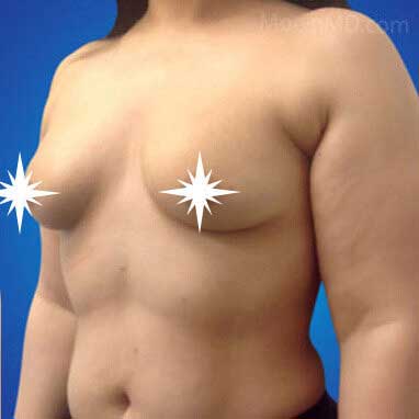 Breast Augmentation- LA-Before