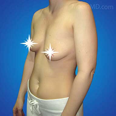 Breast Augmentation & Lift in Los Angeles-Before