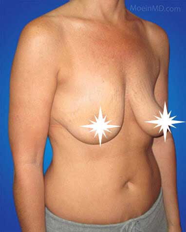 Breast Augmentation & Lift in Los Angeles-before
