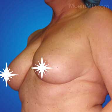 Breast Augmentation- Los Angeles-Before