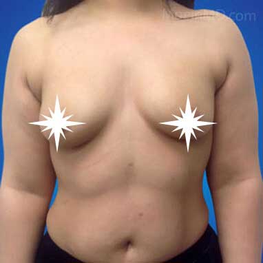 Breast Augmentation- Los Angeles-Before
