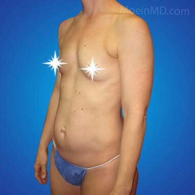 Breast Augmentation- Los Angeles CA-Before