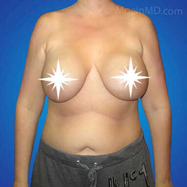 Breast Augmentation and Lift Before - Los Angeles CA