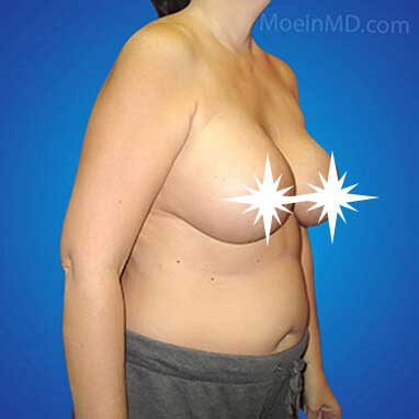 Breast Augmentation and Lift Before- Los Angeles