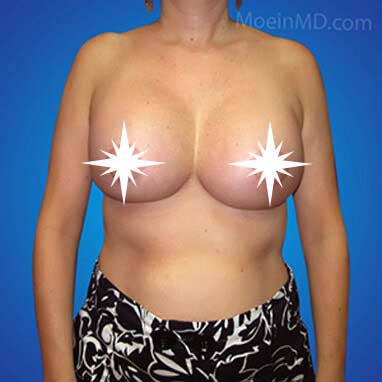 Breast Augmentation and Lift- LA-After