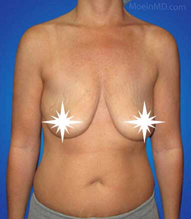 Breast Augmentation and Lift- LA-Before