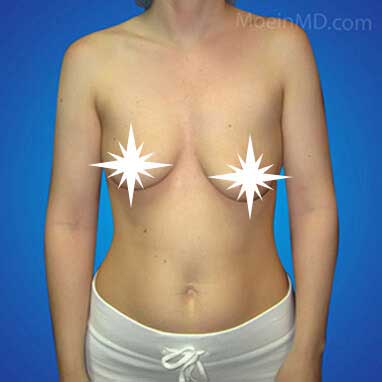 Breast Augmentation and Lift- Los Angeles-Before
