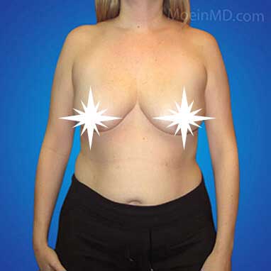 Breast Augmentation and Lift- Los Angeles-Before