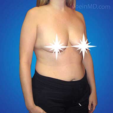 Breast Augmentation and Lift- Los Angeles CA-Before
