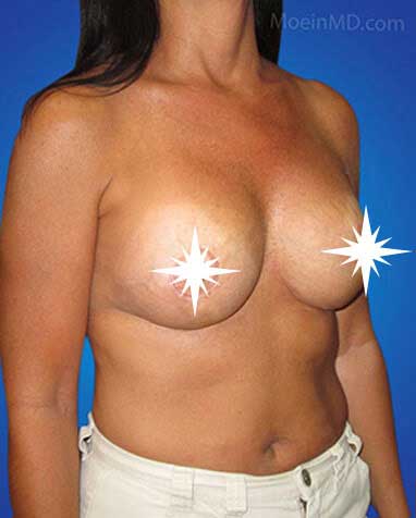 Breast Augmentation and Lift- Los Angeles CA-after