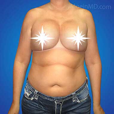Breast Augmentation and Lift aftrer- LA