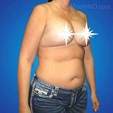 Breast Augmentation and Lift in LA After