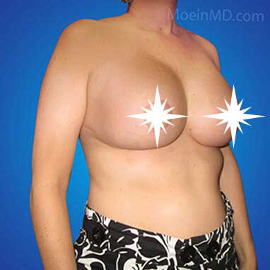 Breast Augmentation and Lift in LA-after