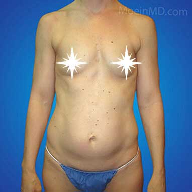 Breast Augmentation in Los Angeles-Before