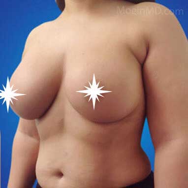 Breast Augmentation in Los Angeles CA-After