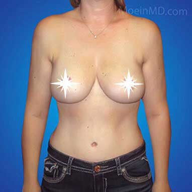 Breast Reduction-After