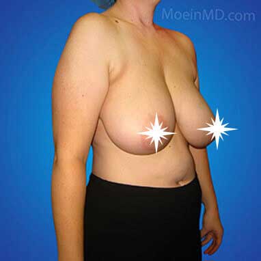 Breast Reduction- LA-Before