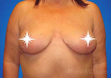 Breast Reduction- Los Angeles-After