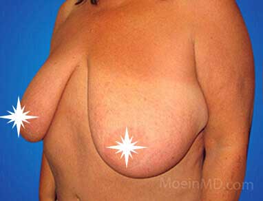 Breast Reduction- Los Angeles- CA-Before