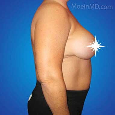 Breast Reduction- Los Angeles CA-Before