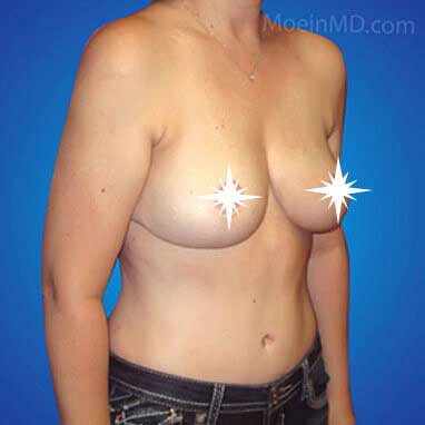 Breast Reduction in LA-After
