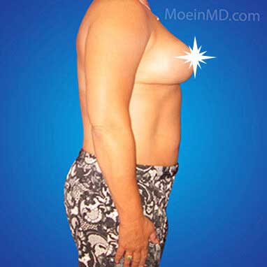 Breast Reduction in LA-After