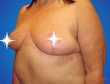 Breast Reduction in Los Angeles- After