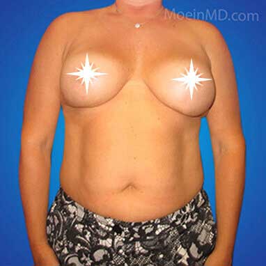 Breast Reduction in Los Angeles CA-After