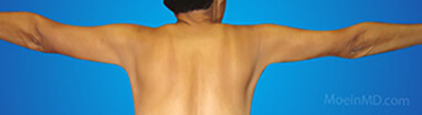 arm fat liposuction after