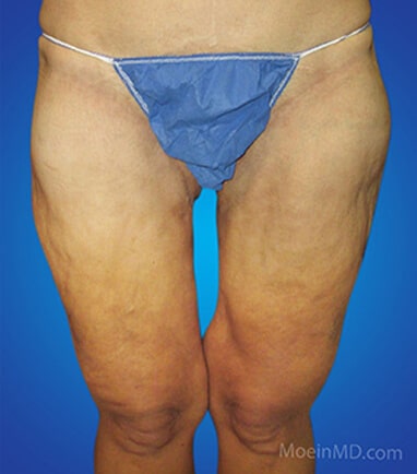 Medial thigh lift after
