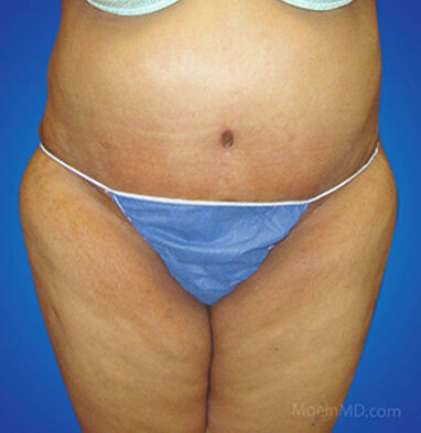 Full tummy tuck with associated liposuction to waist and abdomen after