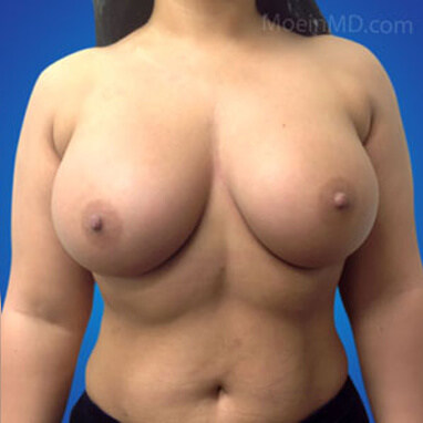 Breast Augmentation with silicone implants 575cc after