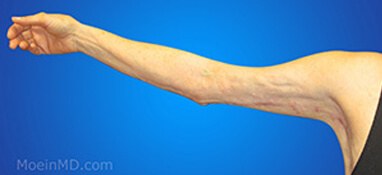 After picture of arm liposuction