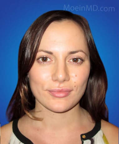 Rhinoplasty after image