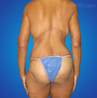 Body lift surgery