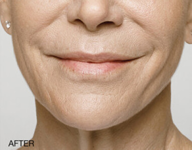 lip fillers after