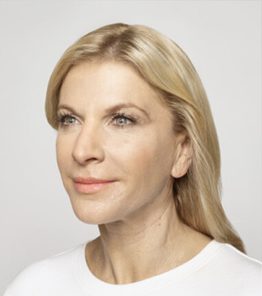 best dermal filler for vertical lip lines after