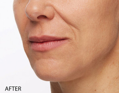 Dermal fillers after