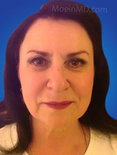 Total facial rejuvenation with deep cheek filler injection after