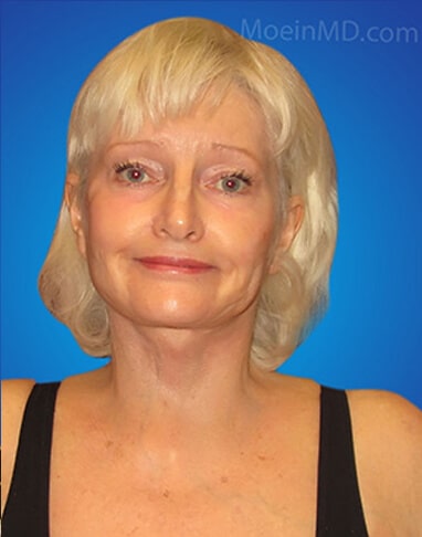 face lift after