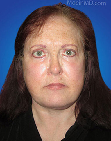 Full lower face and neck lift, upper and lower blepharoplasty with fat grafting and laser skin resurfacing after