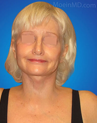 face and neck lift after