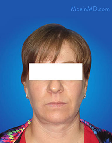 neck lift after