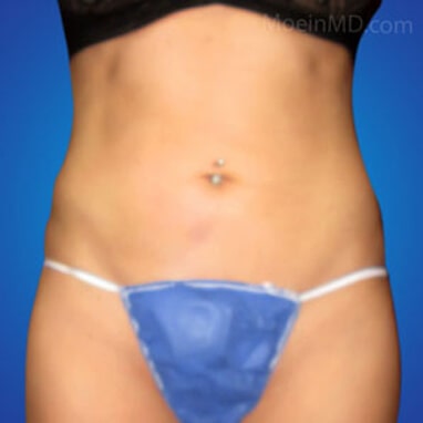 Liposuction abdominal after