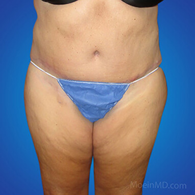 lipo lower abdomen after