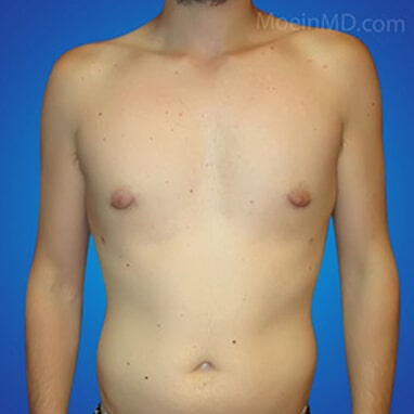 male breast reduction surgery after