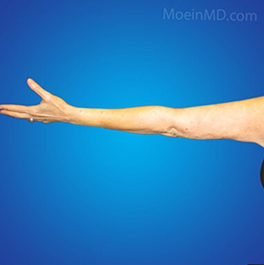 upper arm liposuction